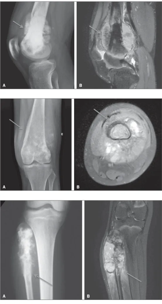 Figura 1. Osteossarcoma do fêmur distal apresentando reação periosteal espiculada (setas), bem demonstrada na radiografia convencional (A) e na ressonância  magné-tica (B).