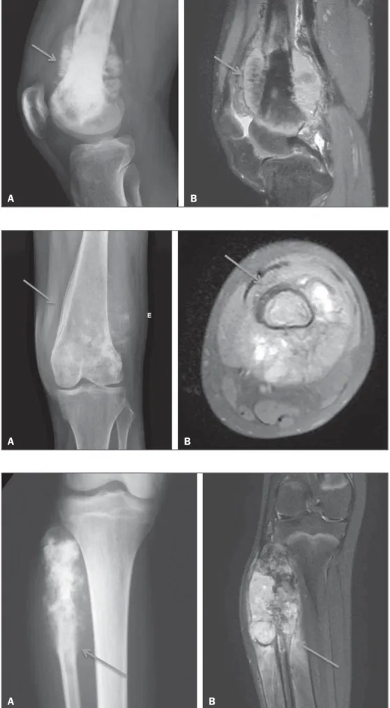 Figure 1. Osteosarcoma of the distal fe- fe-mur presenting a spiculated periosteal  re-action, well demonstrated by CR (arrow in A) and MRI (arrow in B).