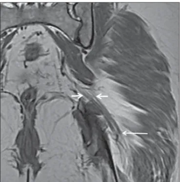 Figura 2. Paciente de 48 anos, sexo masculino, schwannomatose. A: Recons- Recons-trução volumétrica (MIP) de corte coronal ponderado em T2 com saturação de gordura mostrando schwannomas em ambos os nervos ciáticos (setas)