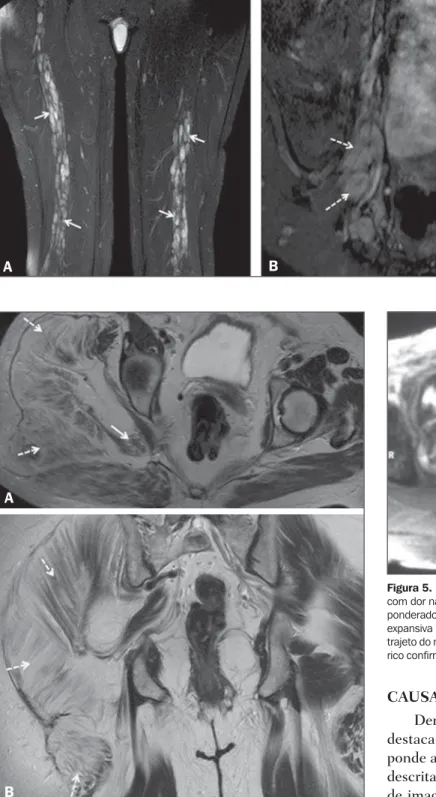 Figura 5. Paciente de 32 anos, sexo masculino, história de neurofibromatose, com dor na perna e aumento de volume da região glútea esquerda