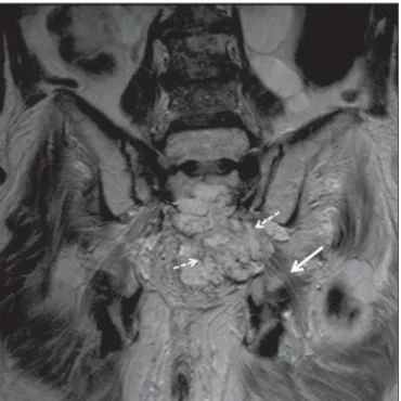Figura 7. Paciente de 35 anos, sexo masculino, massa palpável na coxa es- es-querda. Corte axial ponderado em T1 demonstrando lipossarcoma (seta tracejada) no compartimento posterior da coxa esquerda, comprimindo e deslocando o  ner-vo ciático ipsilateral 