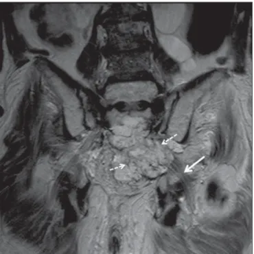 Figure 7. 35-year-old male patient with a palpable mass in the left thigh. Axial T1-weighted slice showing a liposarcoma (dashed arrow) in the posterior  com-partment of the left thigh, compressing and displacing the ipsilateral sciatic nerve (solid arrow)