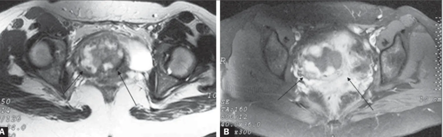 Figure 2. A: Coronal T2-weighted MRI showing that the myometrium (arrows) was ruptured by the gestational mass