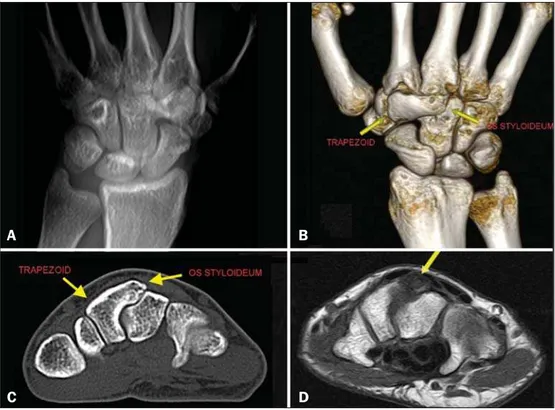 Figure 1. A: Digital X-ray showing a lack of definition of the joint space between the trapezoid and the capitate