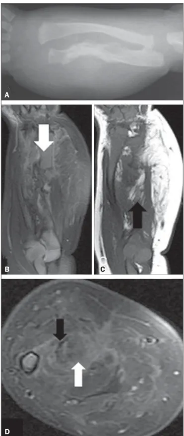 Figura 1. A: Radiografia do antebraço demonstrando fratura associada a irregu- irregu-laridade da ulna, arqueamento do rádio, aumento da espessura e densidade das partes moles do antebraço