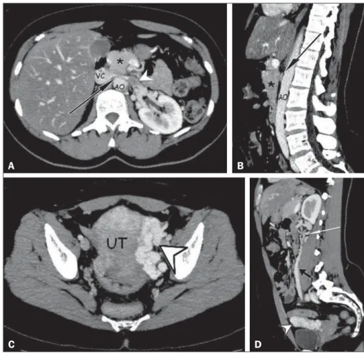 Figure 1. A,B: Contrast-enhanced arterial-phase CT of the abdomen, in the axial plane and in sagittal reconstruction, respectively,  character-izing clots within the proximal portion of the LRV (white arrowhead), showing a reduction in its caliber at the a