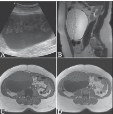 Figure 1. Ultrasound (A); sagittal T2-weighted MRI sequence (B); out-of-phase T1-weighted gradient-echo MRI sequence (C); and in-phase T1-weighted  gradi-ent-echo MRI sequence (D)