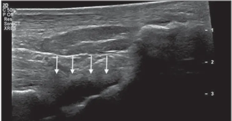 Figure 1. Longitudinal sagittal image of the tibiotarsal joint space, performed with a linear transducer at 14 MHz, showing hypoechoic areas (arrows),  charac-teristic of effusion.