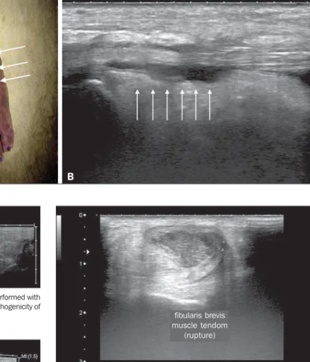 Figure 2. A: Photo of the dor- dor-sal region of the left foot, which shows anterolateral bulging (arrows)