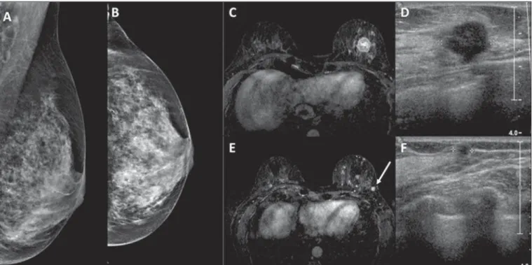 Figura 2. Paciente com mamas densas na mamografia (A,B). Ressonância magnética e ultrassonografia (C,D) mostram o tumor principal na mama esquerda como nódulo irregular