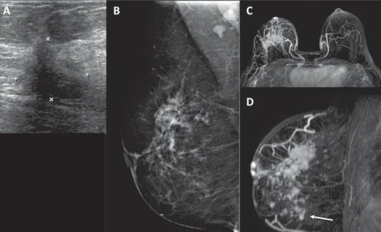 Figure 2. Patient with dense breasts on mammography (A,B). MRI and ultrasound (C,D) showing the primary tumor as an irregular mass in the left breast