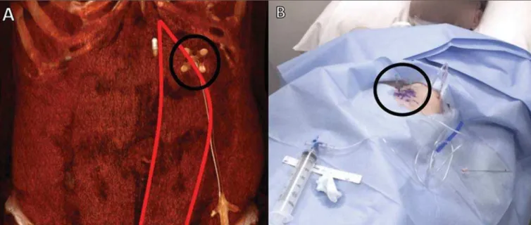 Figure 2. Fixation of the gastric wall for CT-guided percutaneous gastrostomy. Introduction of the needle cannula at one of the points of the previously marked triangle (A)