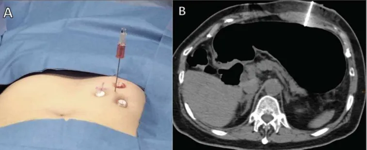 Figure 3. Gastric puncture for CT-guided percutaneous gastrostomy. A puncture needle is placed in the center of the previously established triangle (A) and the stomach is transfixed (B).
