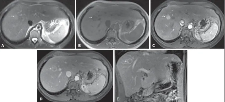 Figure 1. Typical HCC in a patient with chronic hepatitis-C. Axial fat-suppressed SS-FSE T2-WI (A), axial in-phase precontrast (B) and postcontrast fat-suppressed 3D- 3D-GRE T1-WI in the arterial (C) and interstitial (D,E) phases