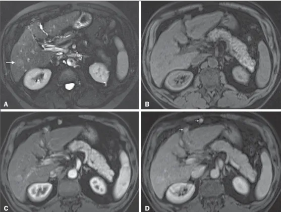 Figure 3. HCC in a patient with chronic alcoholic liver disease. Axial fat-suppressed SS-FSE T2-WI (A), axial pre- (B) and postcontrast fat-suppressed 3D-GRE  T1-WI in the arterial (C) and interstitial (D) phases