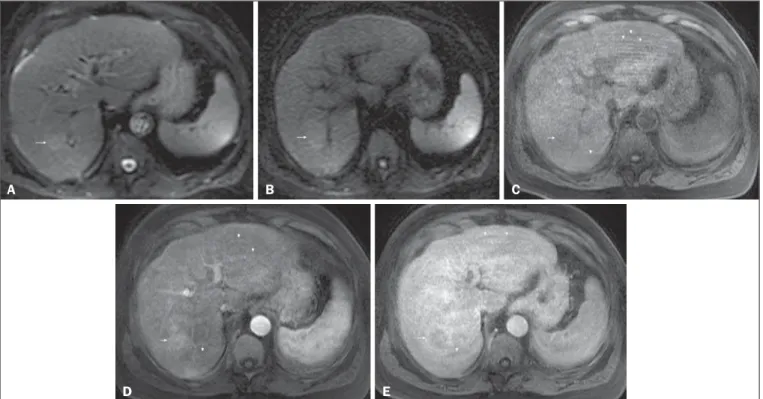 Figure 4. HCC in a patient with chronic hepatitis-C unable to fully cooperate with the recommended breath-holds on the dynamic GRE sequences