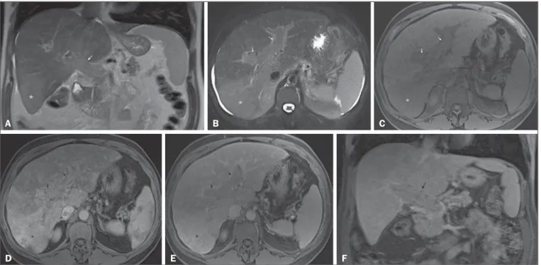 Figure 7. Diffuse HCC in a patient with chronic hepatitis C. Coronal SS-FSE T2-WI (A), axial fat-suppressed SS-FSE T2-WI (B), axial pre- (C) and postcontrast fat- fat-suppressed 3D-GRE T1-WI in the arterial (D) and interstitial (E) phases, and coronal post