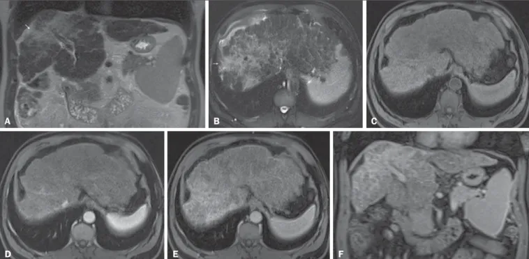 Figure 8. Liver cirrhosis with confluent fibrosis. Coronal (A) and axial fat-suppressed (B) SS-FSE T2-WI, axial pre- (C) and postcontrast fat-suppressed 3D-GRE T1-WI in the arterial (D) and interstitial (E) phases, and coronal postcontrast fat-suppressed 3