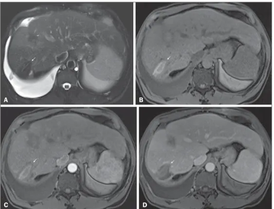 Figure 10. Post-microwave ablation of HCC in a patient with chronic hepatitis C.