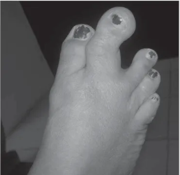 Figure 1. Photograph of the right foot, showing an enlarged second toe and a palpable hard bony lump on its medial aspect.