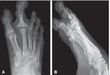 Figure 2. Plain radiographs, in the anteroposterior and oblique planes (A and B, respectively), of the right foot, showing marked hypertrophy of the second toe with associated enlargement of the soft tissue and phalanges; near complete obliteration of meta