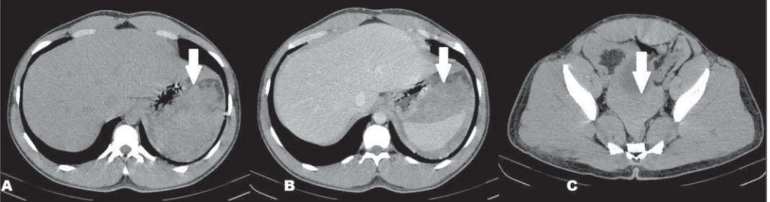 Figure 1. CT scan showing subcapsular hematoma and hemoperitoneum. A: CT, axial slice, without contrast, demonstrating dense collections (arrow) adjacent to the spleen