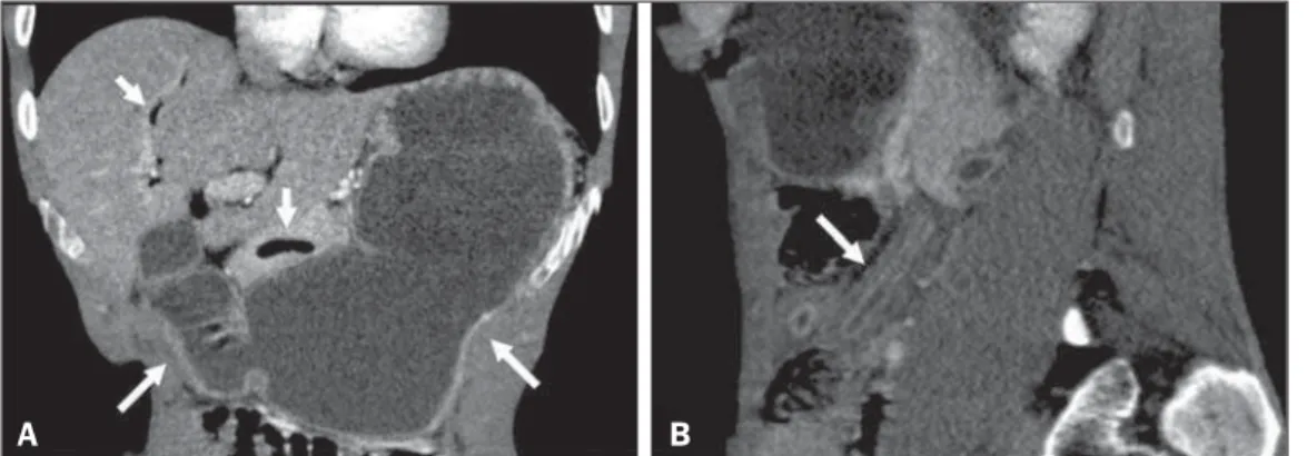 Figura 2. TC com contraste intrave- intrave-noso, imagens nos planos coronal (A) e sagital (B) mostrando acentuada distensão gástrica e duodenal (setas longas em A) associada a gás na árvores biliar e pancreática (setas curtas em A), e com o sinal de “cano