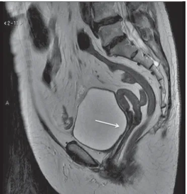 Figura 1. Imagem de RM solicitada para avaliação de recorrência de tumores pélvicos de paciente com câncer de colo uterino após conização