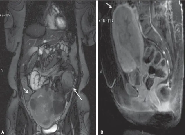 Figura 3. Imagem de RM solicitada para diagnóstico de lesão anexial. Cortes coronal T2 (A) e sagital T1 (B) pós-contraste demonstram lesão infiltrativa heterogênea ocupando a cavidade endometrial, com invasão de mais de 50% da espessura miometrial (setas m