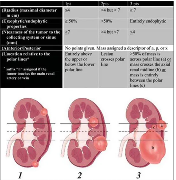 Figure 1. R.E.N.A.L. nephrometry score with scoring of (L)ocation  com-ponent. Polar lines (solid lines) and axial renal midline (broken line) are depicted on each sagittal view of kidney