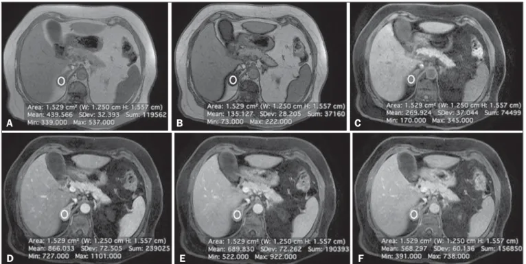 Figure 2 shows an adenoma in which the PE was cat- cat-egorized as type 1. Among the 127 adenomas evaluated, the PE was categorized as type 1 in 49 (47.6%), type 2 in 50 (48.5%), and type 3 in 4 (3.9%)