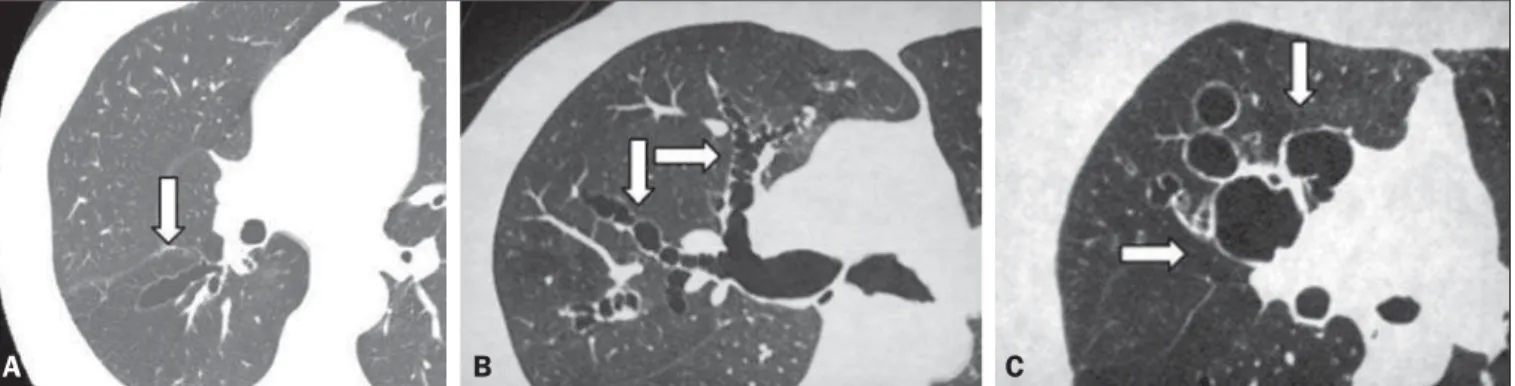 Figure 2. CT of the chest in patients with different patterns of bronchiectasis (arrows)