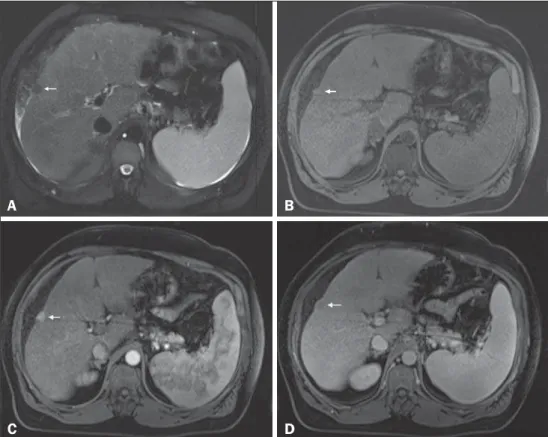 Figure 1.  Small HCC. Axial SSFSE T2- T2-weighted image, with fat suppression (A), axial pre-contrast 3D-GRE T1-weighted  im-age, with fat suppression (B), and axial  post-contrast 3D-GRE T1-weighted images, with fat suppression, in the arterial and  inter