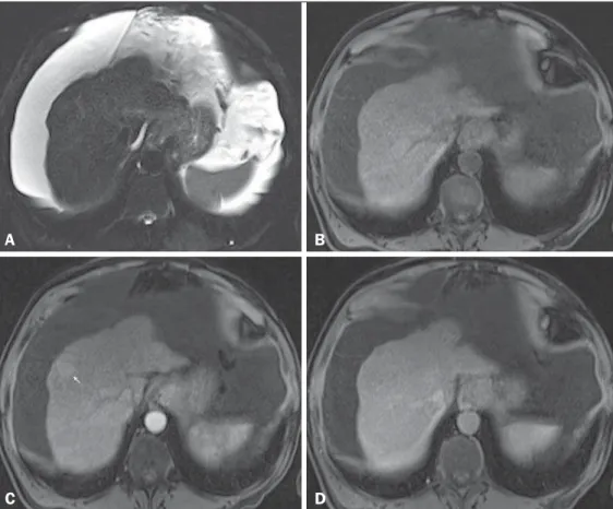Figure 4. High-grade dysplastic nodule vs. perfusion abnormality. Axial FSE  T2-weighted image, with fat suppression (A), axial pre-contrast 3D-GRE  T1-weighted image, with fat suppression (B), and axial post-contrast 3D-GRE  T1-weighted images, with fat s