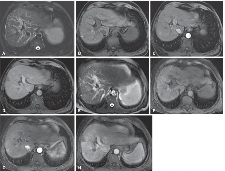Figure 5. Progression from high-grade dysplastic nodule to HCC in a patient with a history of chemoembolization for HCC
