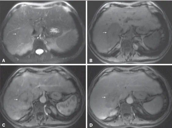 Figure 7. Typical HCC in a patient with chronic hepatitis C. Axial SSFSE  T2-weighted image, with fat suppression (A), axial pre-contrast in-phase 3D-GRE T1-weighted image, with fat suppression (B), and axial post-contrast in-phase  3D-GRE T1-weighted imag