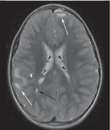 Figure 2. A 12-year-old boy with tuberous sclerosis complex. Axial T2-weighted image shows cortical tubers as well-circumscribed areas of high signal intensity (white arrows) and subependymal nodules along the ventricular surface (black arrowheads)