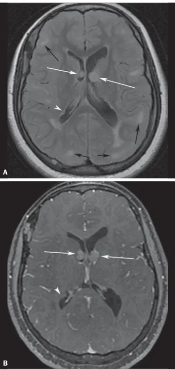 Figure 4. A 52-year-old woman with tuberous sclerosis complex. Axial (A,B) and coronal (C) CT mini–maximum-intensity projection images show numerous  bilat-eral, variably sized thin-walled cysts, compatible with lymphangioleiomyomatosis.