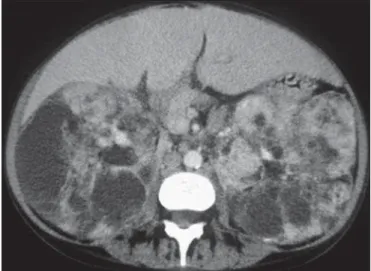 Figure 6. A 38-year-old man with tuberous sclerosis complex and renal lipid-poor angiomyolipoma