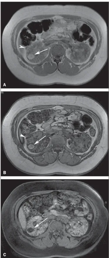 Figure 8. A 21-year-old woman with tuberous sclerosis complex and multiple renal angiomyolipomas