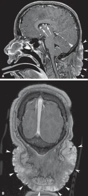 Figure 11. A 22-year-old woman with tuberous sclerosis complex and sclerotic spinal bone lesions
