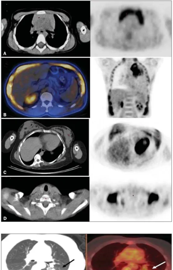 Figure 1. Causes of physiological FDG up- up-take in the thorax. A: A 6-year-old boy, with normal metabolic activity in the thymus