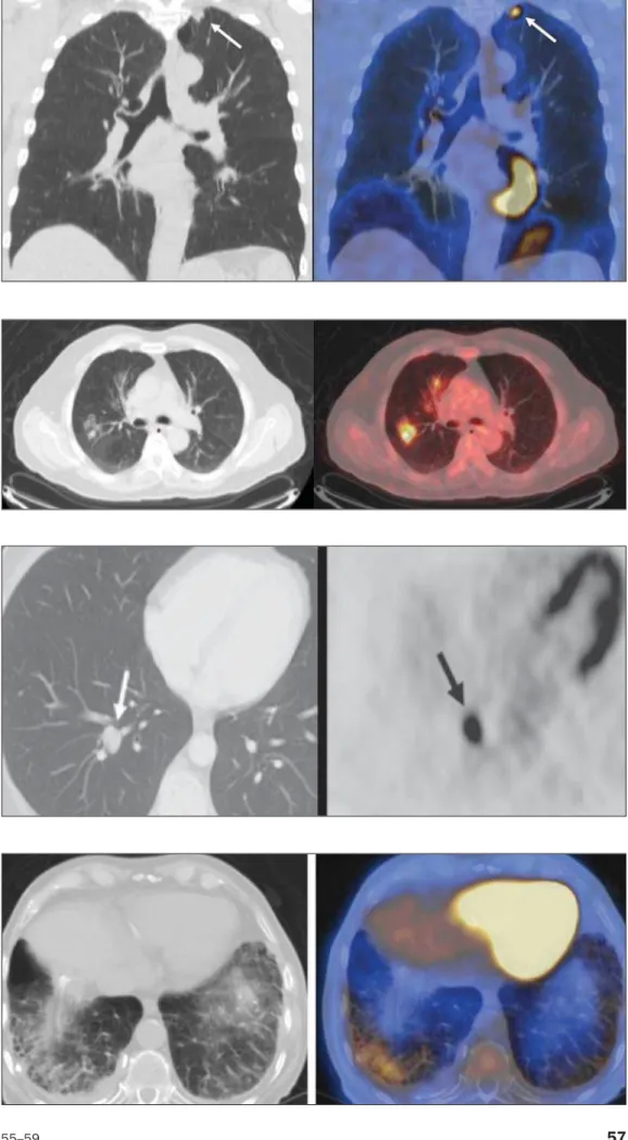 Figure 6. A 81-year-old man with an occupational history of asbestos  ex-posure. PET/CT images demonstrate high metabolic activity in the left lower lobes, especially in the cortical regions.