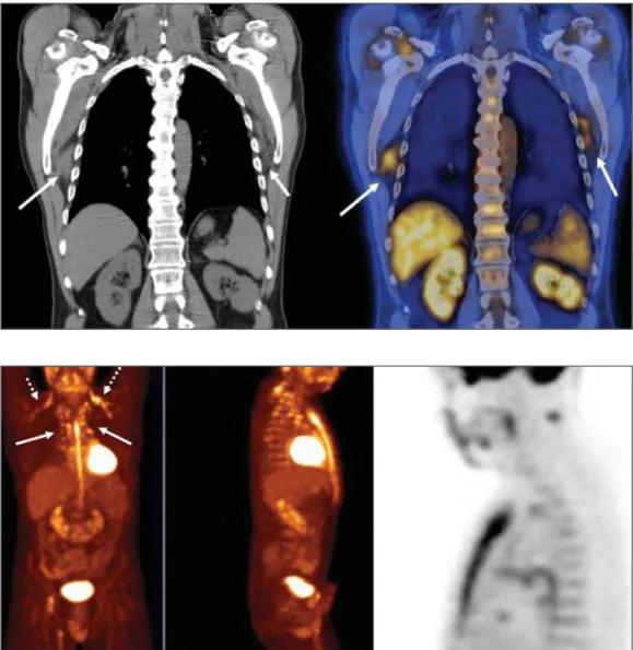 Figure 7. A 78-year-old woman sub- sub-mitted to PET/CT for the staging of a cervical carcinoma, with increased FDG uptake in bilateral subscapular masses (arrows), consistent with elastofibroma dorsi.