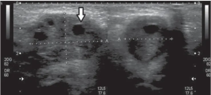 Figura 2. Ultrassonografia do grande lábio vulvar direito. Notar a continuidade do pedículo do órgão para o canal inguinal (seta).