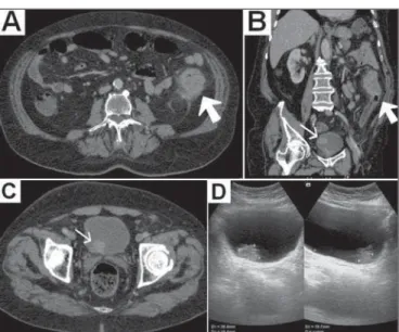 Figure 1. A,B: Computed tomography scan of the abdomen, obtained in the portal phase after intravenous administration of contrast medium, in an axial view (A) and oblique coronal reconstruction (B), showing a solid, irregular, concentric mass, which was ex