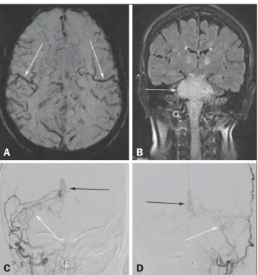 Figure 1. A: Axial slice in a susceptibility-weighted sequence showing numerous large-caliber superficial veins, representing venous congestion