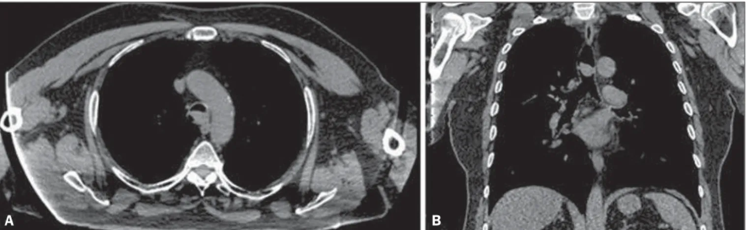 Figure 1. A: Axial CT scan, without contrast, showing an extensive, well-defined nodular mass in the distal trachea, measuring 2.1 × 1.3 × 1.7 cm, without signs of tracheal wall invasion