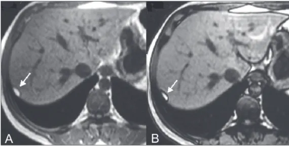 Figure 2. Pseudolipoma of Glis- Glis-son’s capsule. A: Axial in-phase T1-  weighted GRE sequence shows a  small subcapsular hyperintense  le-sion (arrow)