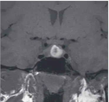 Figura 1. Sequências pós-contraste dinâmicas coronais ponderadas em T1  mostrando realce mais lento que o parênquima hipoisário de microadenoma  na asa esquerda da adeno-hipóise (setas).